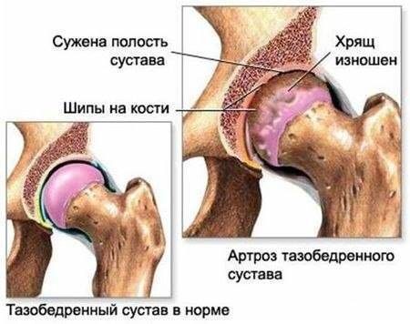 тазобедренный сустав тазобедренный сустав