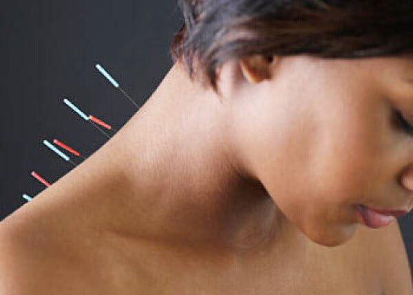 Акупунктура, или иглоукалывание (иглорефлексотерапия) Одесса