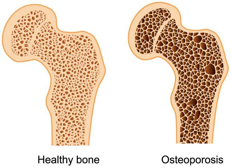 причины хрупкости костей при остеопорозе