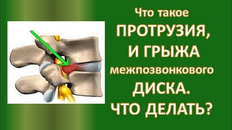 протрузия межпозвонкового диска