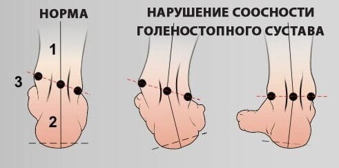 Гимнастика для коррекции и лечения плоскостопия.