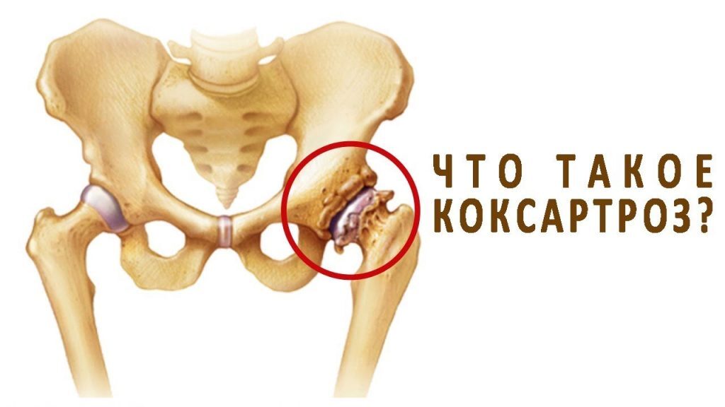 Коксоартроз