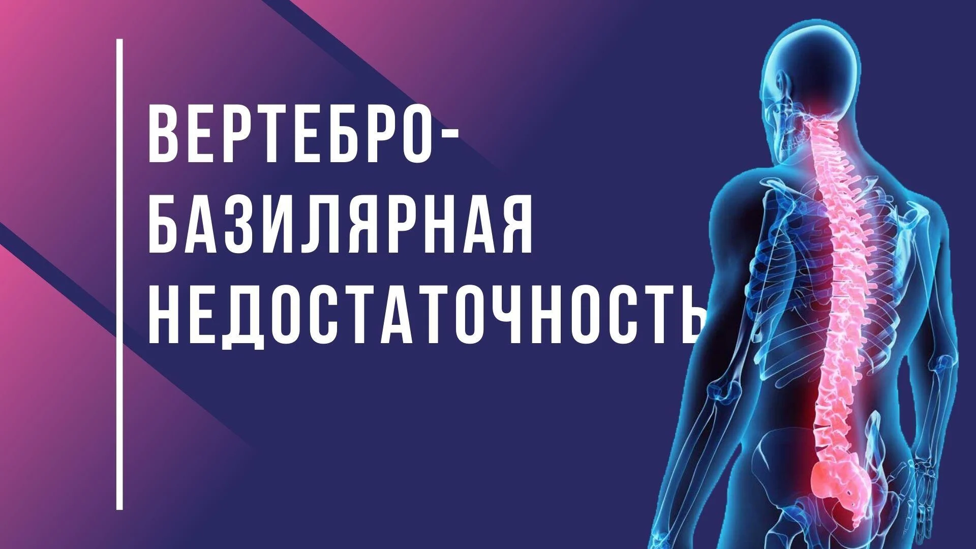 Вертебро-базилярная недостаточность