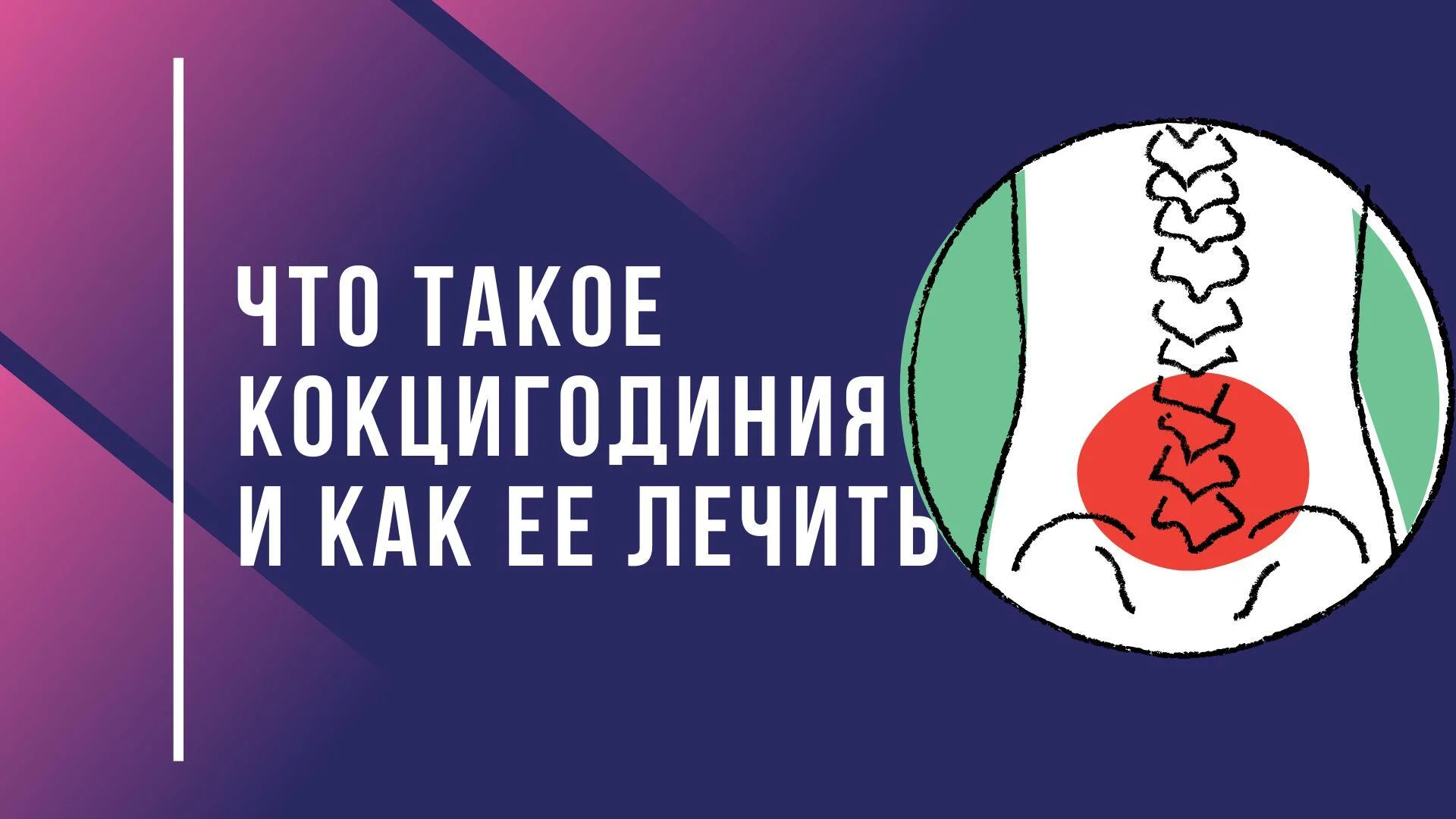 Что такое кокцигодиния и как ее лечить