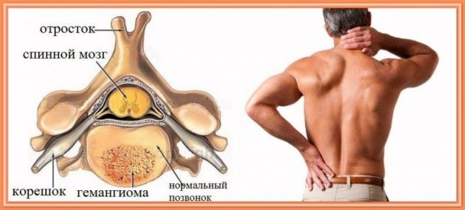 Гемангиома позвоночника