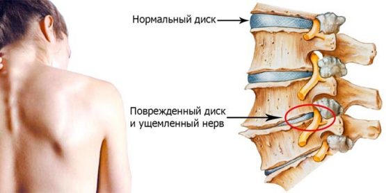 Лечение остеохондроза