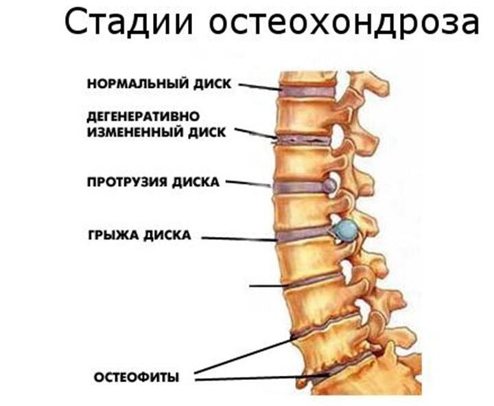 Стул при остеохондрозе поясничного отдела