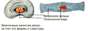 межпозвонковая грыжа