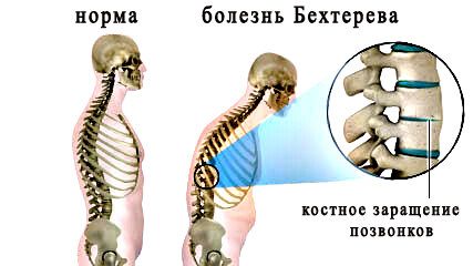 Болезнь Бехтерева