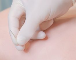 Голковколювання-одеса