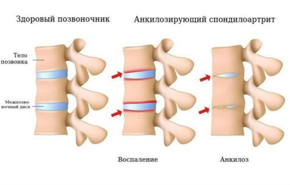 Анкилозирующий-спондилоартрит