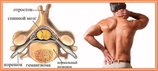 Гемангиома позвоночника